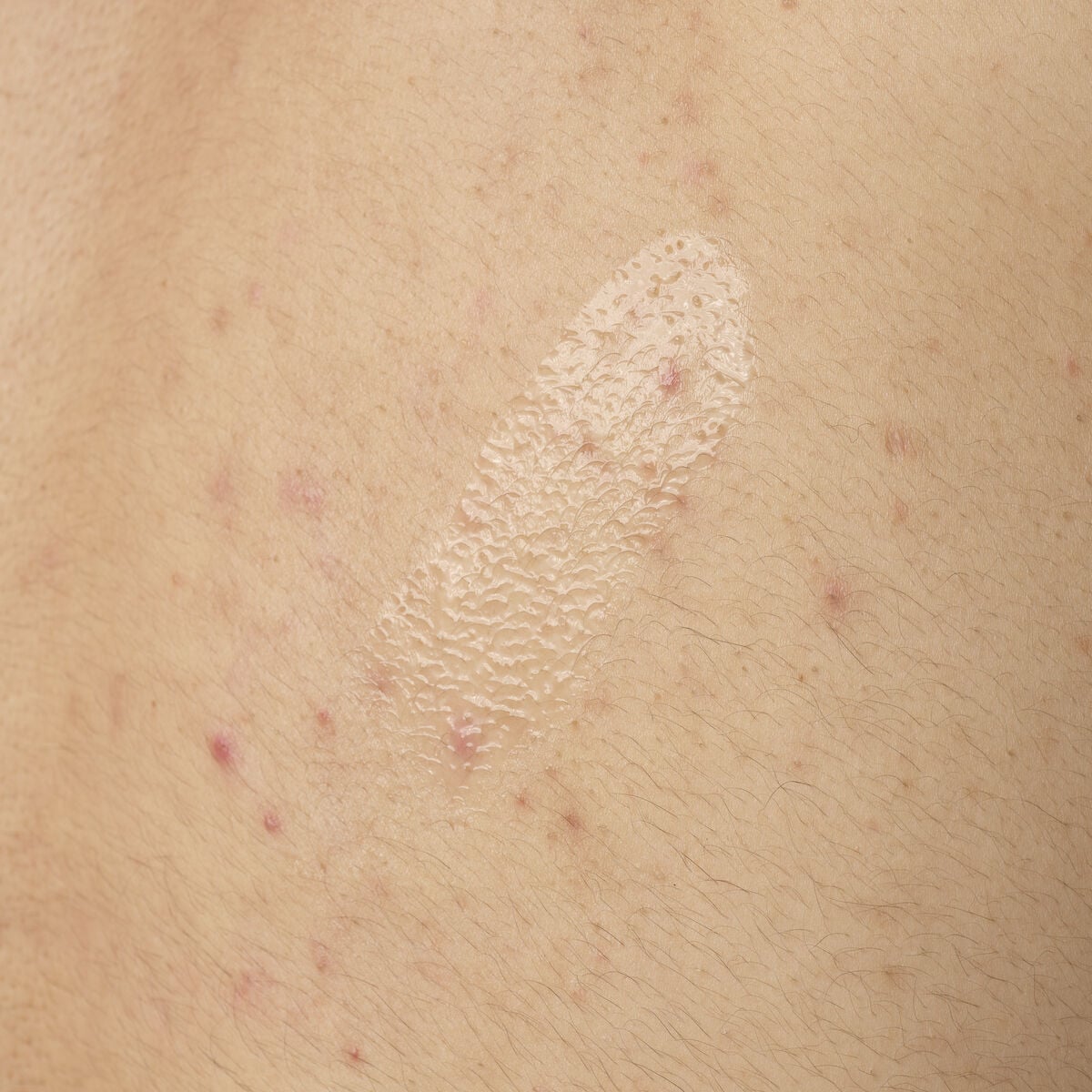 salicylic-acid-0-5-body-serum-p3 ORD-salicylic-acid-05-body-240ml-application.jpg