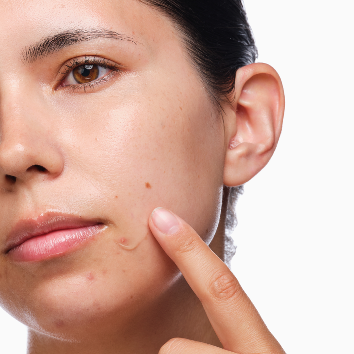 the-acne-set-k8 rdn-the-acne-set-application.png