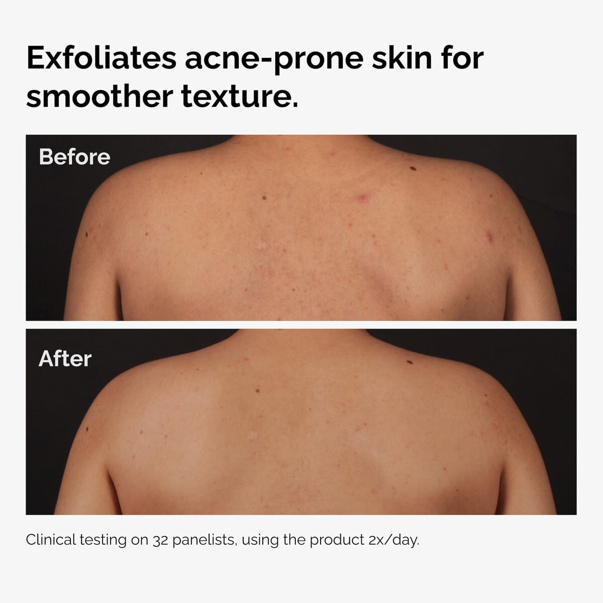 salicylic-acid-0-5-body-serum-p3 ord-salicylic-acid-body-serum-before-after-graphic-NA.jpg
